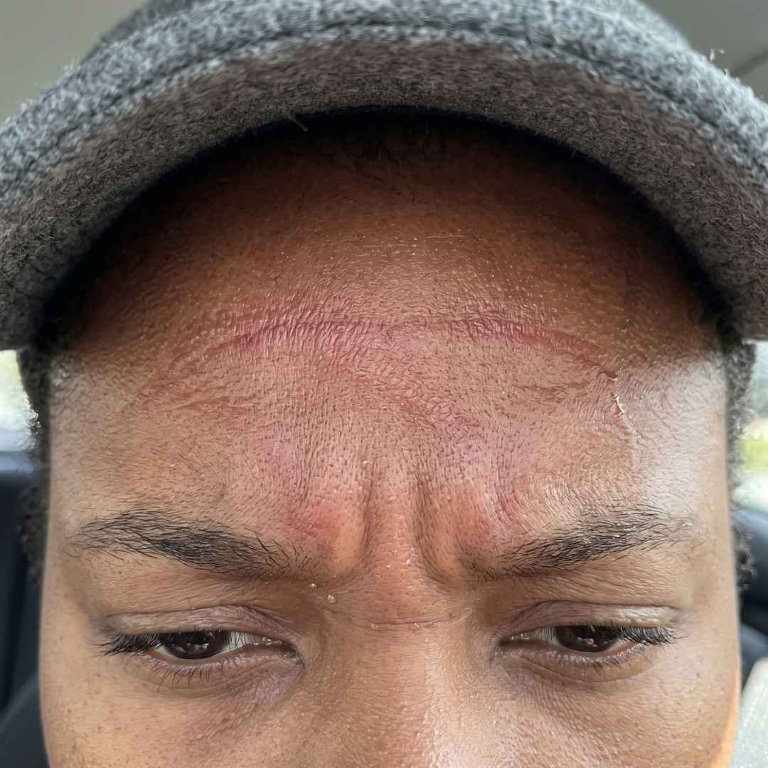 Head Lines Pressure Marks